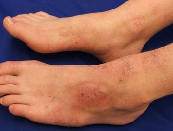Foot Rash Causes Symptoms Treatment