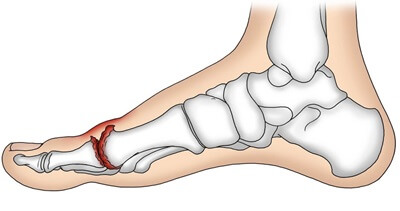 Big Toe Joint Pain & Stiffness: Hallux Rigidus Big Toe Joint Pain & Stiffness: Hallux Rigidus