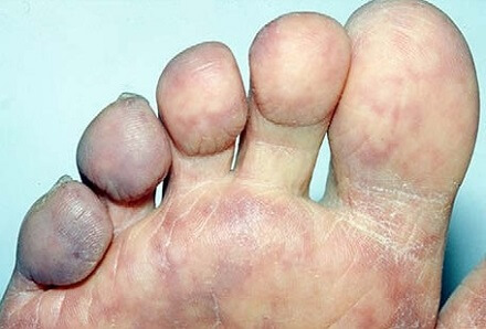 5 Signs of Underlying Disease From Your Feet