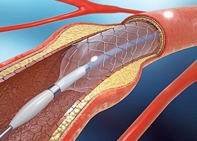 Stenting is a common treatment option used with blue toe syndrome