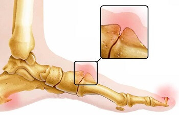 Lump Top Of Foot: Common Causes & Treatment