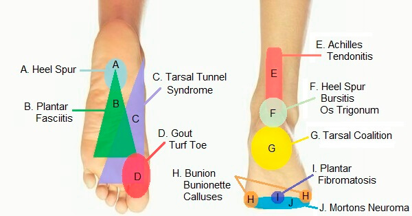 Foot Pain Diagram - Why Does My Foot Hurt?