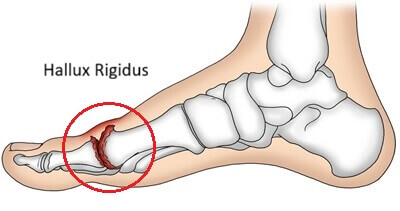 Hard Bump On Big Toe: Hallux Rigidus. Causes, symptoms and diagnosis of hallux rigidus lump on toe