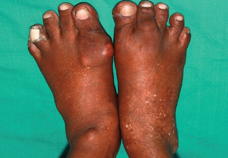 Bump On Big Toe Knuckle: Gout. A painful, red lump on big toe is often due to foot gout. Learn about the causes, symptoms, diagnosis & treatment