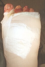 Typical dressing after bunion surgery. Find out everything you need to know about bunion surgery recovery