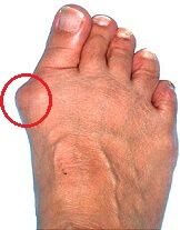A bony lump is one of the most common bunion symptoms