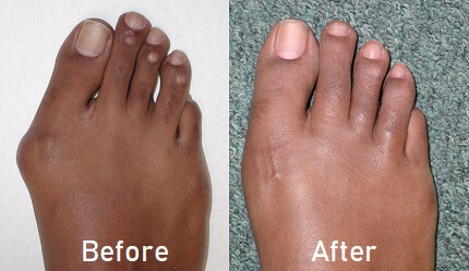 Is It Finally Time To Consider Bunion Surgery?