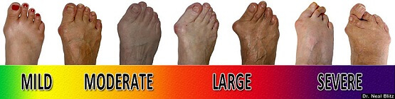 Changes in foot shape and toe position are common bunion symptoms