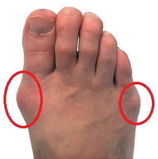 outside foot pain