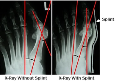 X-ray showing the effective of a bunion splint X-ray showing the effective of a bunion splint