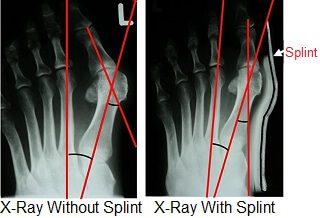X-ray showing the effect of wearing bunion splints.  You can see how the angles of the toe are improved