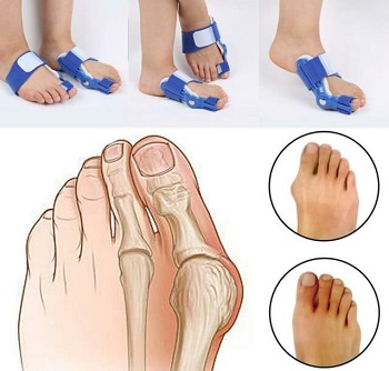 scholl bunion treatment