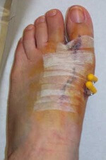 Scar following bunion surgery