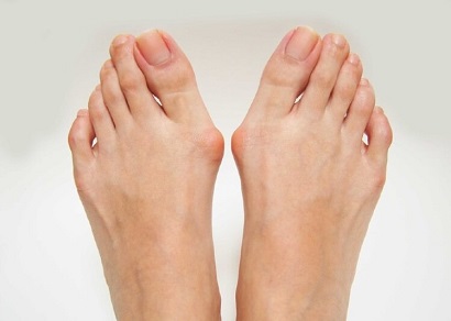 Bunion Symptoms: Find out about the common causes, symptoms and best treatment options for foot bunions Bunion Symptoms: Find out about the common causes, symptoms and best treatment options for foot bunions