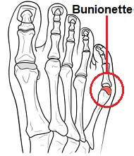 A bunionette or tailor's bunion develops at the little toe