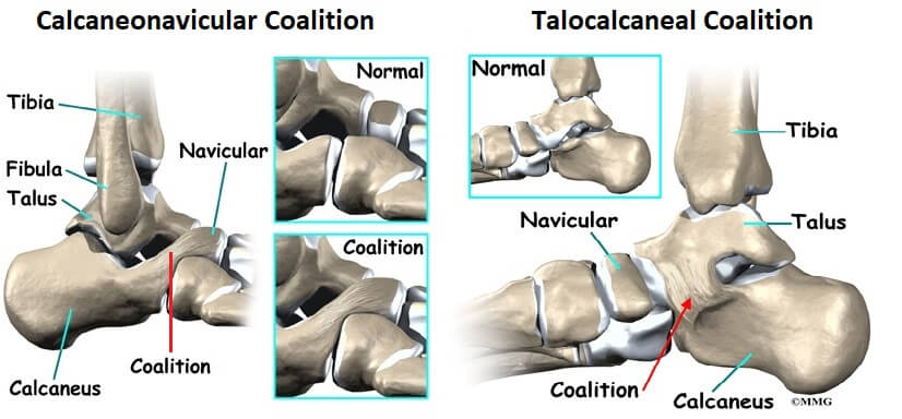 Tarsal Coalition Causes Symptoms Treatment