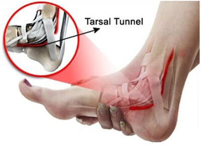 Inner Side Foot Pain: Tarsal Tunnel Syndrome. Causes, symptoms & treatment for burning pain on inside of foot