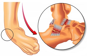 Foot and Ankle Ligament Sprains: The most common ankle injury. Learn about common causes, symptoms, diagnosis, treatment & prevention