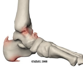 Bone Spurs are common causes of foot pain. Learn about the causes, symptoms, diagnosis & treatment options