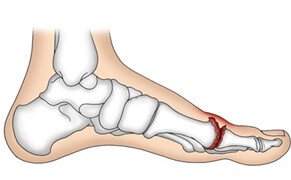 Common Causes Of Foot Pain: Hallux Rigidus - stiff big toe