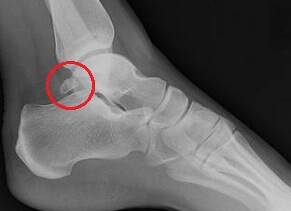 Os Trigonum Foot Pain - Causes, symptoms & treatment options. Commonly affects ballet dancers & sportsmen