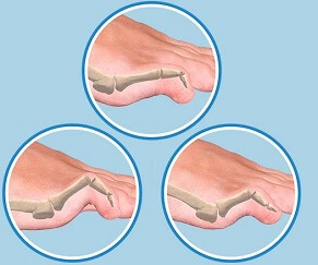 Hammer, Mallet and Claw Toe are common deformities of the toes