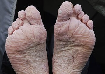 Now a common feature at festivals, trench foot dates back to the awful conditions in the trenches in WW1