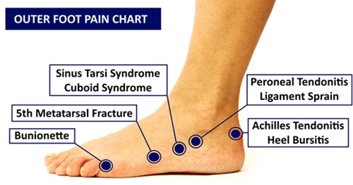 Causes Of Pain On Outside Of Foot: Find out all about the most common causes of outer foot pain with out lateral foot pain diagnosis chart.