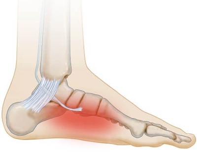 Inner Side Of Foot Pain: Posterior Tibial Tendonitis is the most common cause of pain on the inside of the foot. Find out about the causes, symptoms and treatment