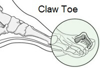Claw toe