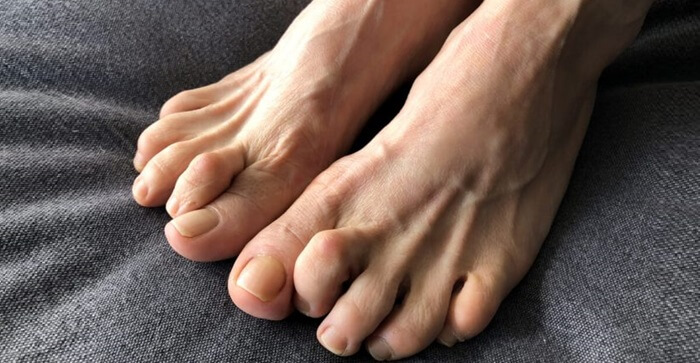 Claw Toe Feet: Common causes, symptoms, diagnosis and treatment