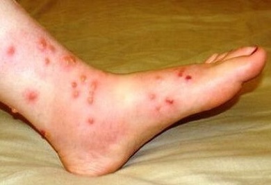 Foot Eczema: Causes, Symptoms & Treatment - Foot Pain Explored