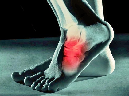 Why the Top of Your Foot Aches After Running | OrthoBethesda