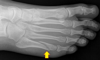 X-ray showing an oblique fracture of the fifth metatarsal shaft - a Dancer's Fracture