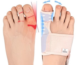 Bunion Corrector Splints help to realign hallux valgus Bunion Corrector Splints help to realign hallux valgus