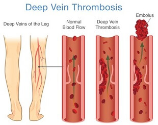 A DVT classically presents with pain, redness, swelling and heat in the calf.  Medical attention should be sought immediately