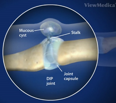 A digital mucous cyst is caused by fluid leaking out the DIP joint through a stalk and forming a small nodule A digital mucous cyst is caused by fluid leaking out the DIP joint through a stalk and forming a small nodule
