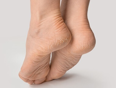 Dry Itchy Feet: Causes, symptoms, diagnosis & treatment