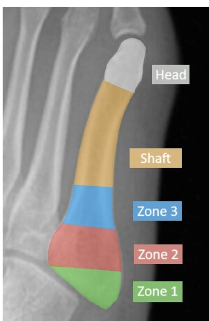 5th Metatarsal Zones: Fractures can occur in different parts of the bone. A dancers fracture occurs in zone 3 / shaft