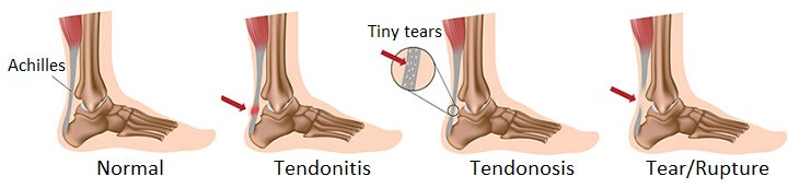 Foot & Ankle Tendon Injuries & How To Treat Them
