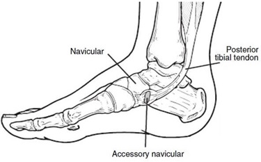 Lump On Side Of Foot: Bunions. Causes, symptoms, diagnosis and treatment of pain on inside of foot foot arch accessory navicular 375 opt oct 23