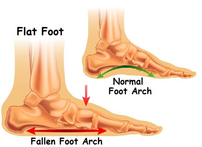 stabbing pain in arch of foot