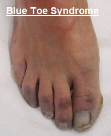 toe blue syndrome foot pain purple toes causes trash blood discoloration symptoms medical treatment