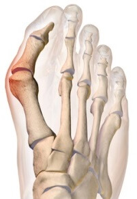 A bunion operation aims to remove excess areas of bone growth and realign the toe. https://commons.wikimedia.org/wiki/File:Bunion.png A bunion operation aims to remove excess areas of bone growth and realign the toe. https://commons.wikimedia.org/wiki/File:Bunion.png