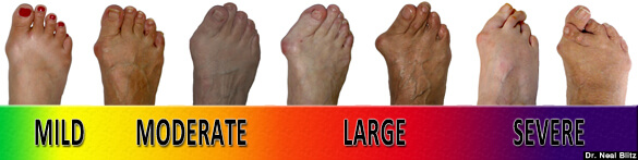 Bunions are a very common cause of big toe joint pain and toe lumps. Find out all about the causes, symptoms, diagnosis and treatment options Bunions are a very common cause of big toe joint pain and toe lumps. Find out all about the causes, symptoms, diagnosis and treatment options