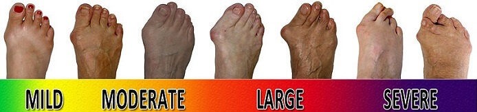 Foot Bunion progression scale