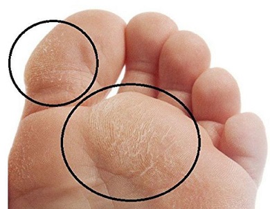 Callus Removal Extra Thick Foot Calluses