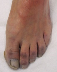 Foot Pain Symptoms