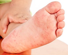 Foot Eczema: Causes, treatment and prevention options