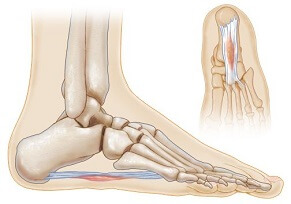 Plantar Fibromatosis, aka Ledderhose Disease, causes foot pain in the sole. Causes, symptoms, diagnosis & treatment